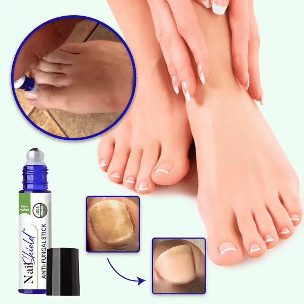 Bâton antifongique NailShield™ | Dites adieu aux mycoses des ongles en seulement 5 jours !